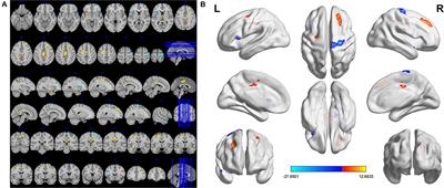 Brain Activity in Different Brain Areas of Patients With Dry Eye During the Female Climacteric Period According to Voxel-Based Morphometry